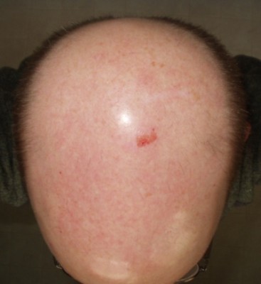 My scraped head