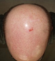 My scraped head